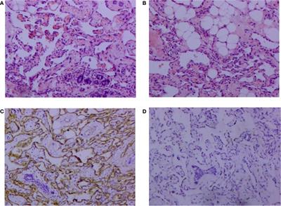 Angiosarcoma of the breast with <mark class="highlighted">hypofibrinogenemia</mark>: A rare case report and review of the literature